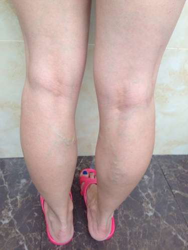 治疗下肢静脉曲张比较彻底的医院