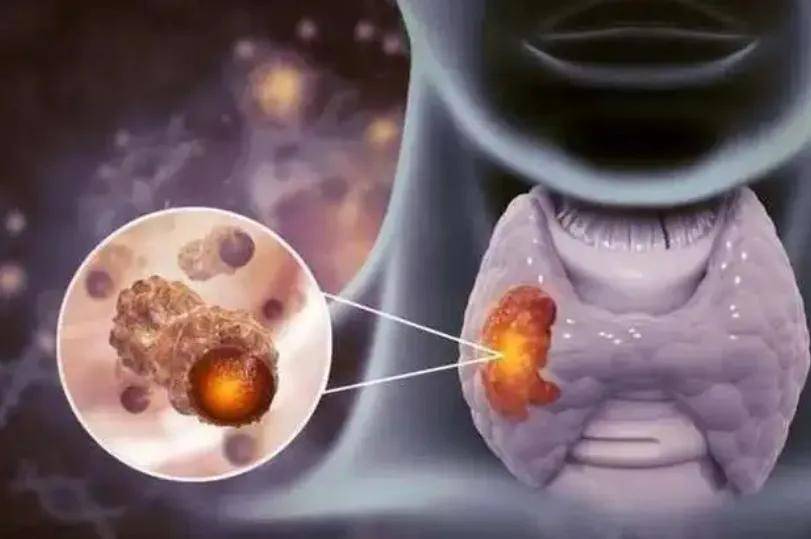 在随访中，判断甲癌复发和转移的检查有哪些？