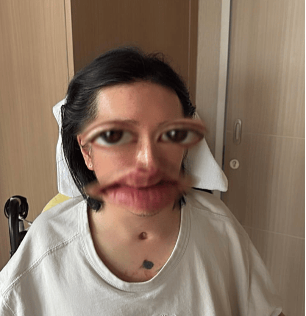 Mirror演唱会事故受伤舞者3年后首晒近照，露出窟窿状伤口