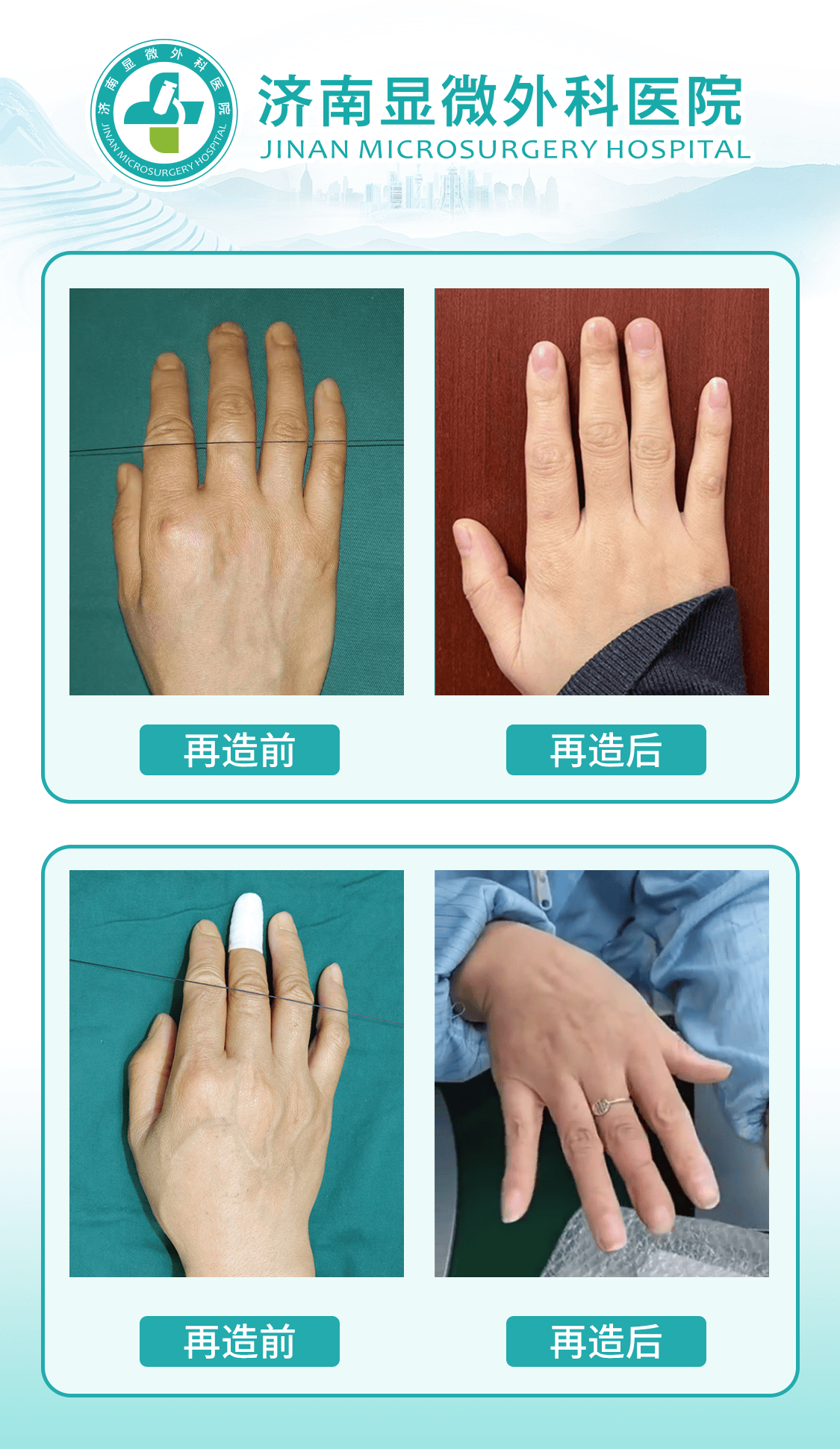 济南显微外科，让这节手指“失而复得”