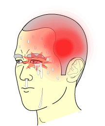 “疼到撞墙、流涕、眼皮耷拉”，原来真有这么狠的头痛？