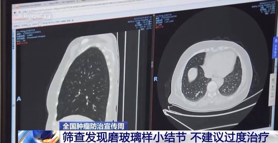 连续10年，全球死亡率第一！这种癌症早期通常无症状，专家提醒