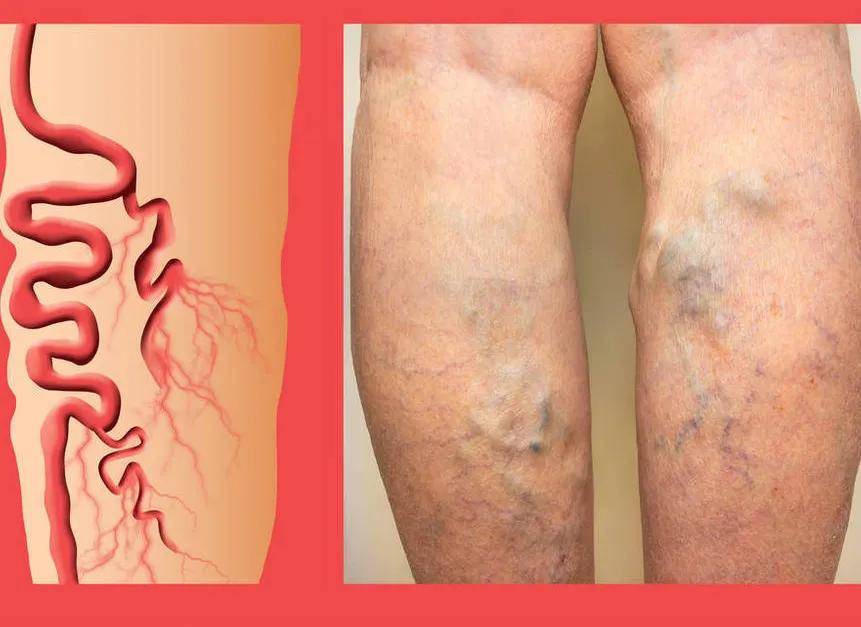 青岛百姓中医院|下肢静脉曲张淤积性皮炎，避免“老烂腿”