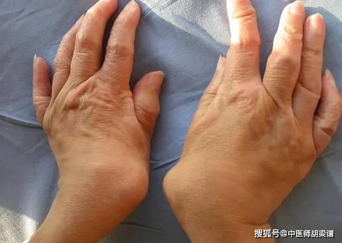 反复肿胀，疼痛变形，别不当回事！当心是类风湿关节炎！