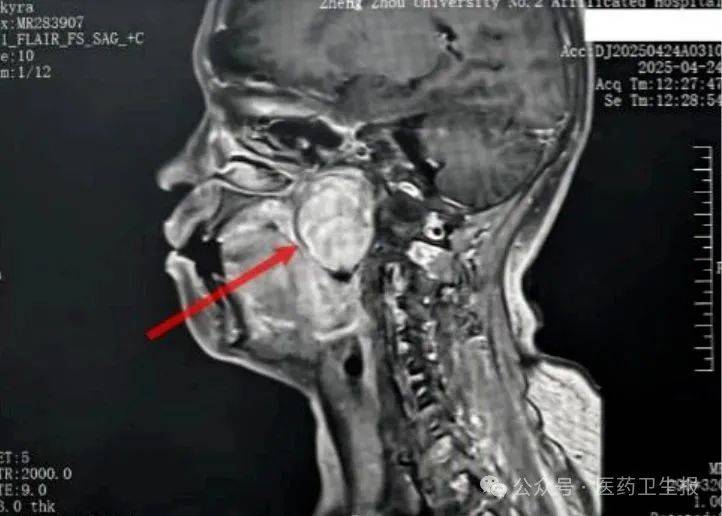 【临床荟萃】经口咽旁间隙切除巨大肿瘤