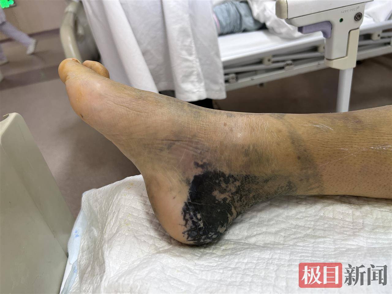 用“知了壳淬白酒”治扭伤，女子外敷三天后脚踝变青黑