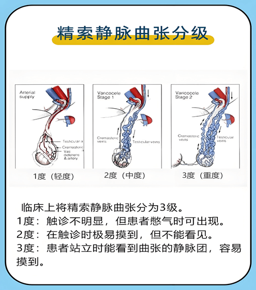 【健康科普】显微镜精索静脉结扎术——助力青年圆梦国防事业