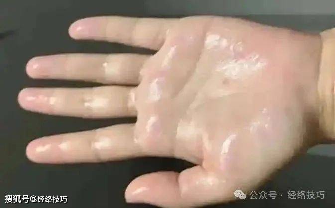 原创            出汗太多别忽视,或是气津失衡信号