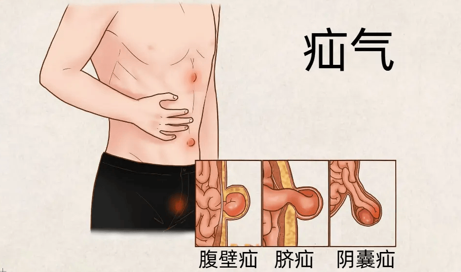 男性疝气发病率高于女性：多因素剖析