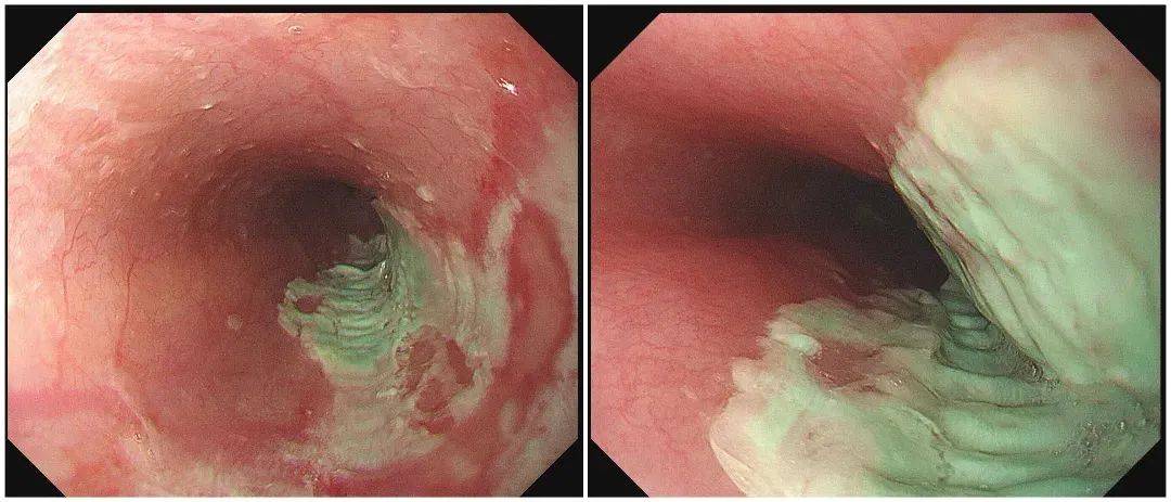 食道被药“割烂”，只因一个错误习惯！