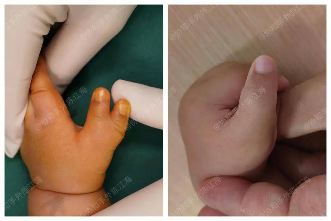 原创            多指│案例35《躺在手术台上，我听见医生多数了一个手指……》