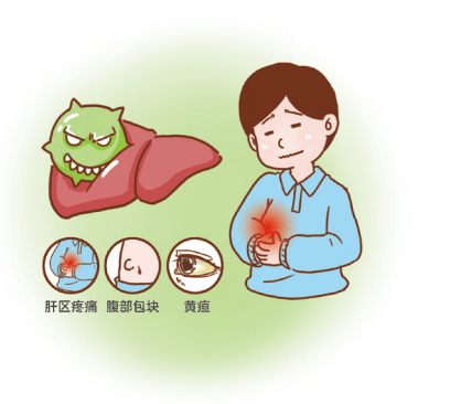 【青岛市居民中西医协同肿瘤防治知识导读（27）】第六篇 常见恶性肿瘤的防治：肝癌