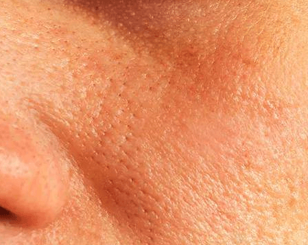 毛孔粗大的原因及注意事项