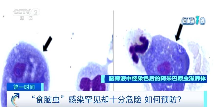 罕见却十分危险！如何预防“食脑虫”感染？医生提醒→