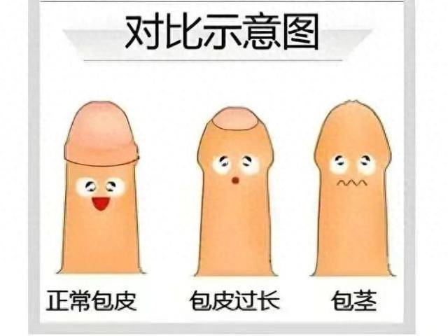 医生提醒不要盲目跟风割包皮 这些情况才需“动刀”