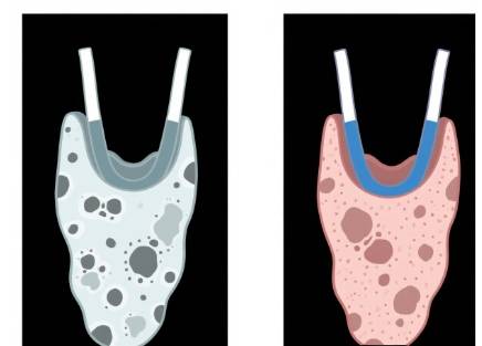 北京菌一生：体检报告上的「钙化」，离癌变有多远？