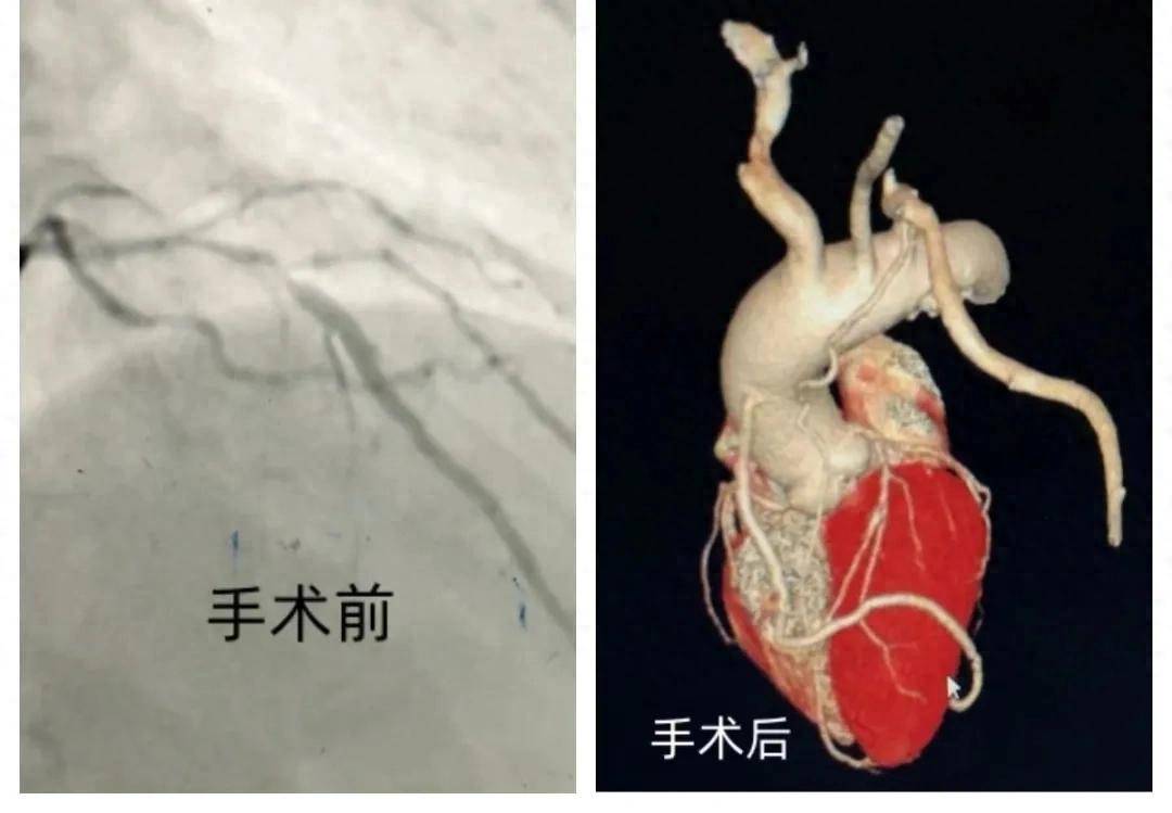 “小切口”代替“大开胸”！微创搭桥手术在河南这家医院已常态化
