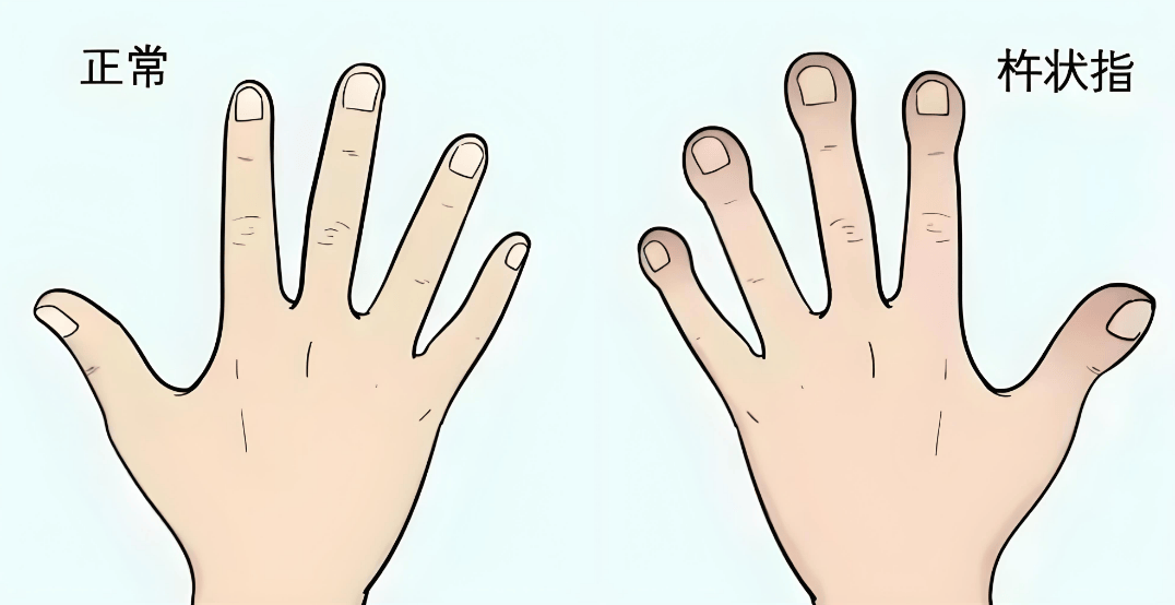 体内有癌，双手先知！手上有这3个变化，小心这几种癌症找上门！