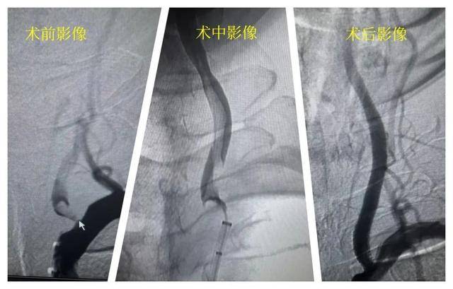 “时间就是大脑” 治疗脑梗塞 把握90分钟“黄金时间窗”！