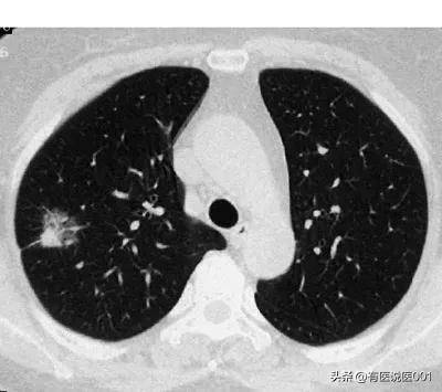 体检查出非小细胞肺癌？别慌！这篇文章帮你理清思路