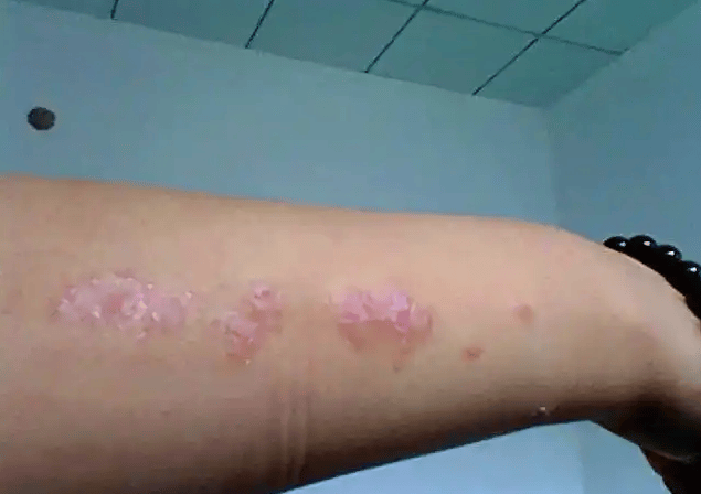 牛皮癣让我差点抑郁，直到遇见这套救命组合