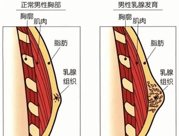 饮食与男性乳腺体发育：需警惕的食物因素