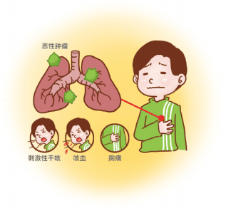 【青岛市居民中西医协同肿瘤防治知识导读（24）】第六篇 常见恶性肿瘤的防治：肺癌