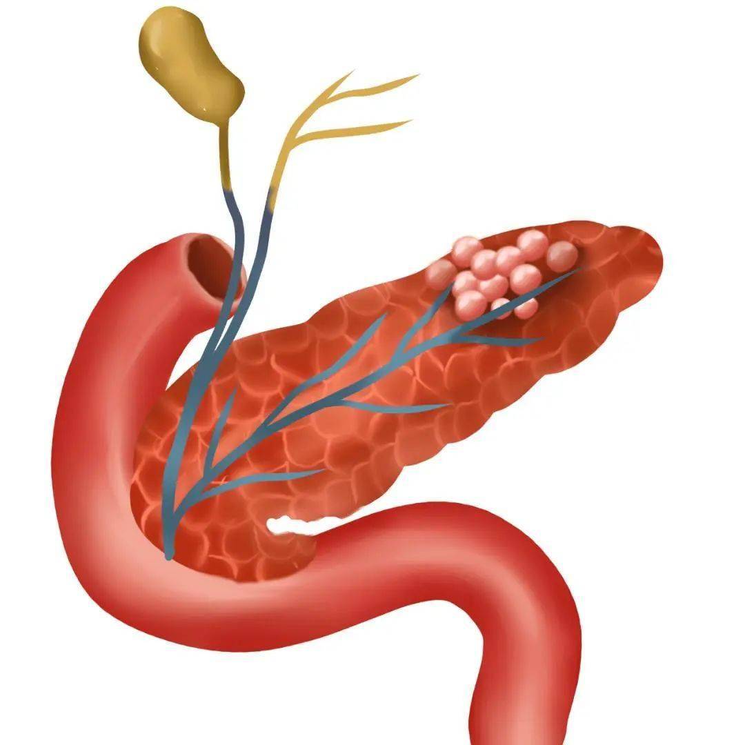 攻克“癌王”新武器！中山大学/深圳大学研究团队提出胰腺癌靶向治疗新方案