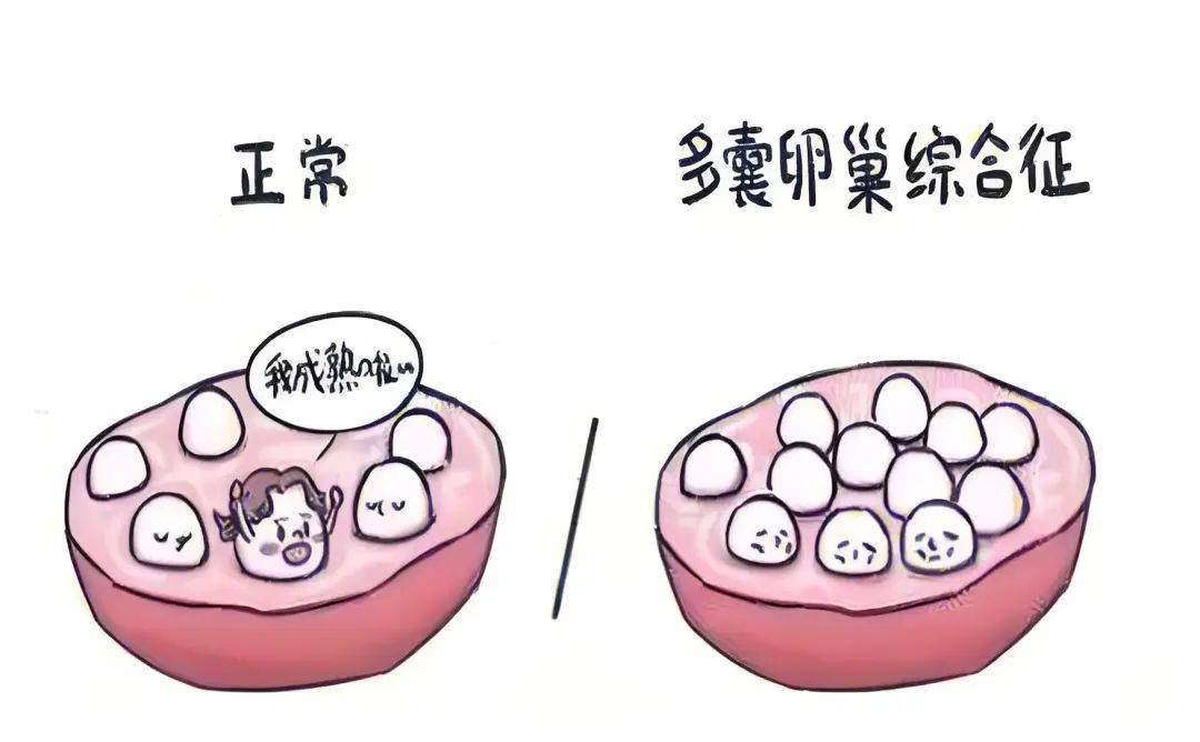 多囊卵巢综合征患者促排卵治疗决策