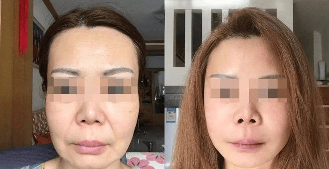 拉皮手术真的能让我变年轻吗？袁强博士|一般多少钱|美容除皱医生|