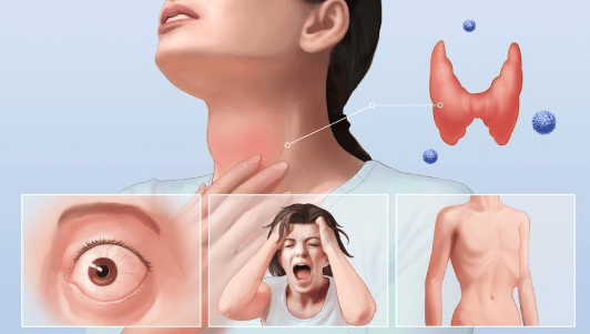 治愈后又重来？揭秘甲亢复发背后的“隐形推手”