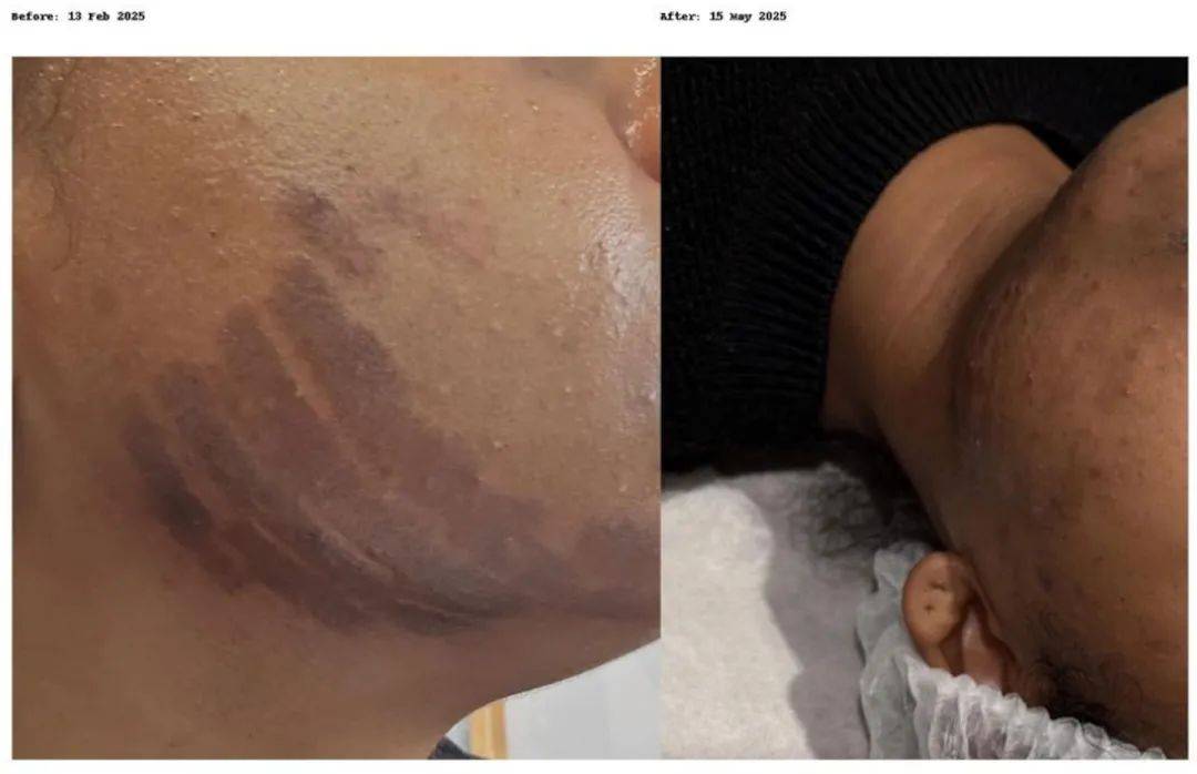 奥克兰女子去美容却被毁容，“脸皮都被烧掉了”