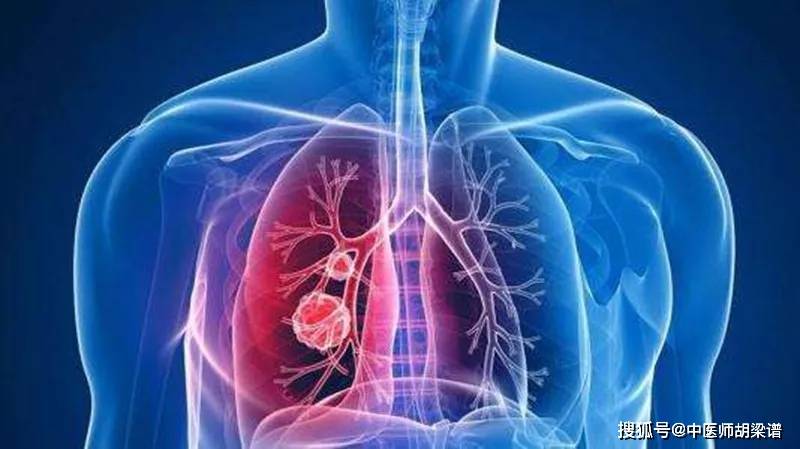 肺磨玻璃结节，一定会癌变吗？别慌，中医教你如何区分