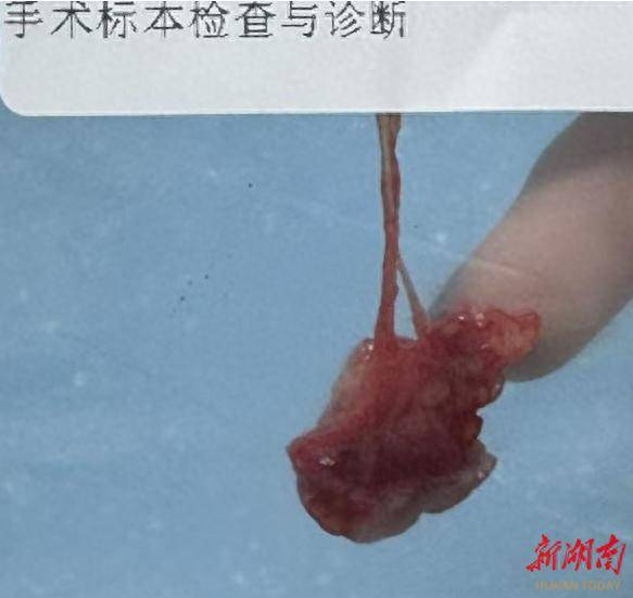 眼皮肿块误当“麦粒肿”，手术后才知是结核