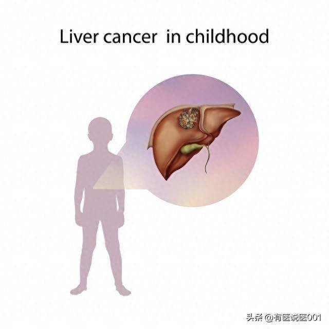 体检查出肝癌怎么办？一文带你全了解！