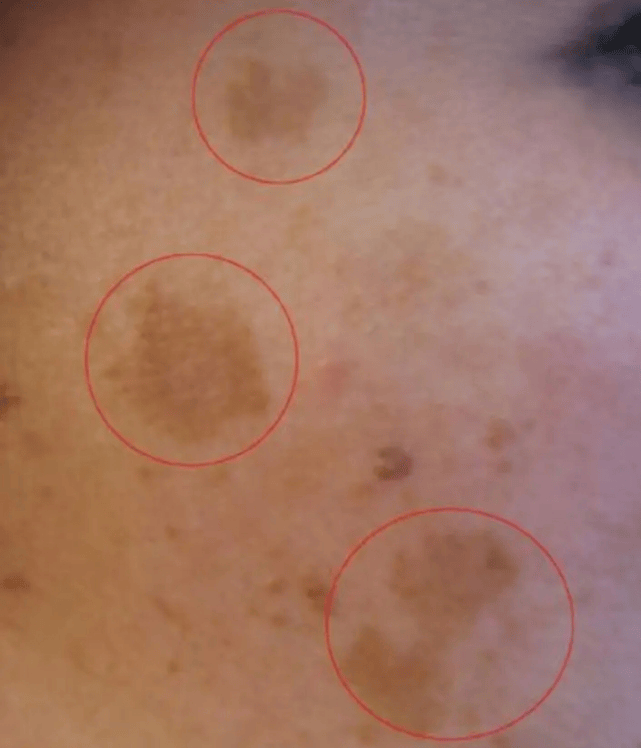 老年斑多少岁会长?女人三十多岁会长老年斑吗