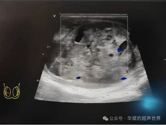 超声问答•这个蜂窝状肿大的睾丸应该如何考虑？