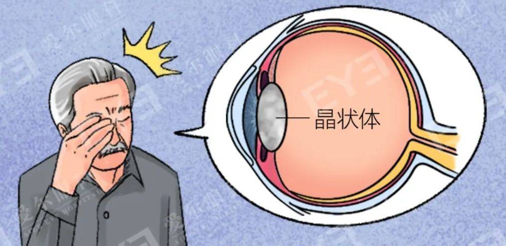 白内障只能等“熟”了再做？专家说：NO！