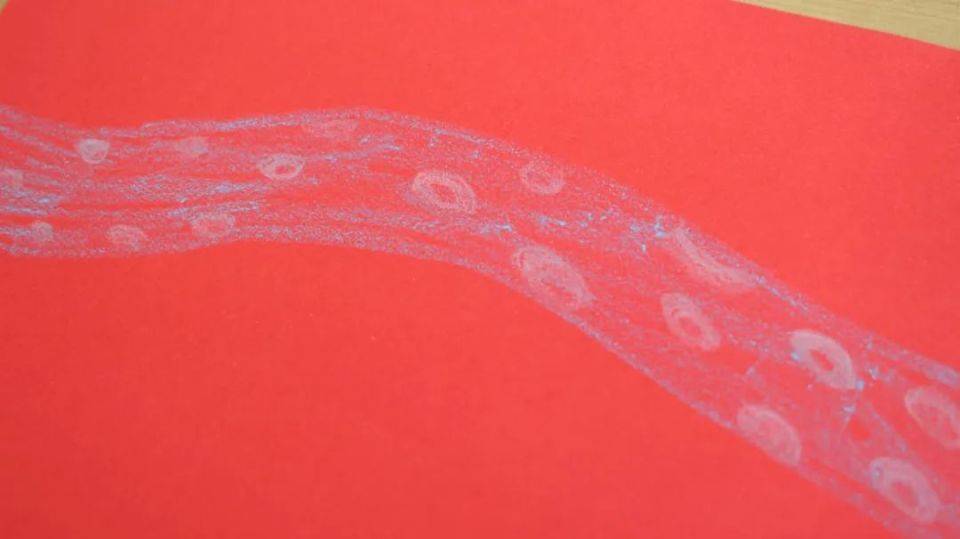 身体有血栓，会出现“2痛、2褶、2红”，若能识别，或可挽救生命