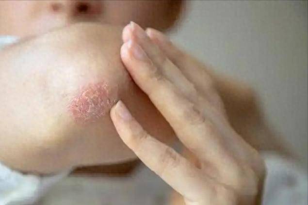 越来越多的人查出湿疹！医生警告：日常这3个习惯，或是“凶手”