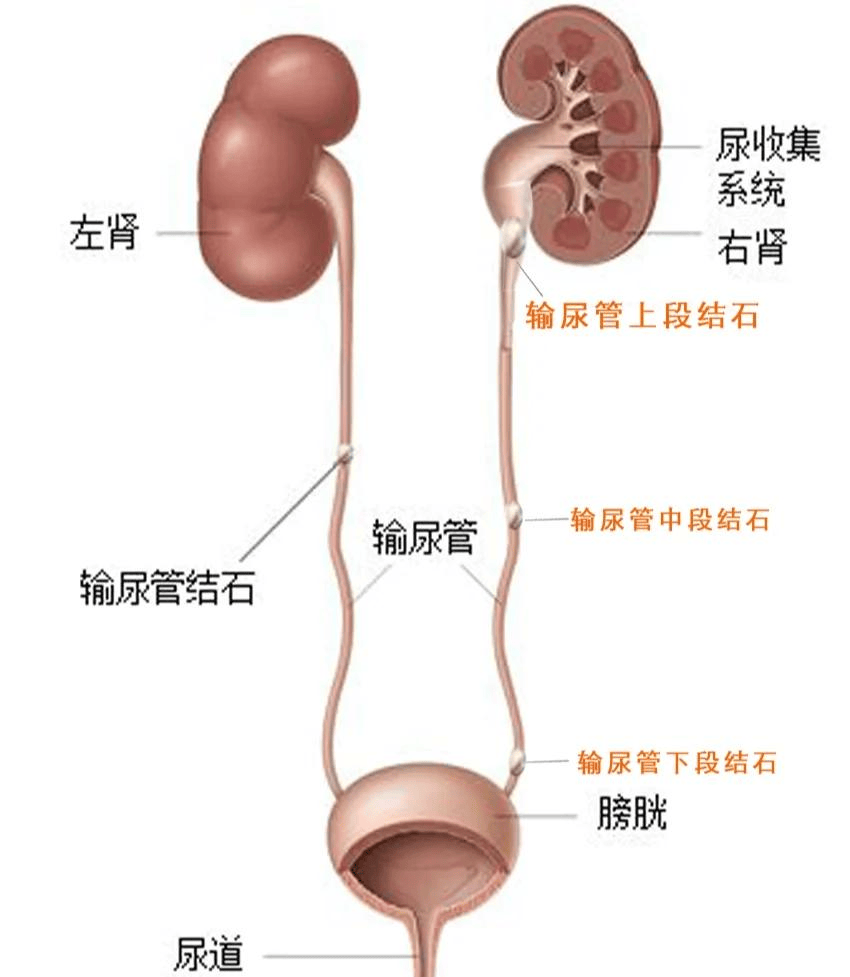 有输尿管结石可以进行性生活吗?