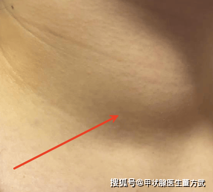 这 6 个症状出现，小心甲状腺结节！