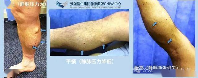 静脉曲张不用切？医生用一个试验，让它3秒消失！