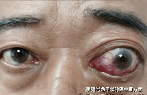 甲亢突眼能恢复正常吗？甲亢患者当如何做好眼部护理？