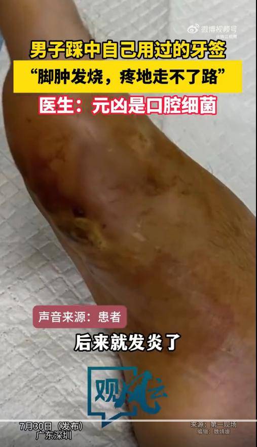 男子踩中自己咬过的牙签整只脚烂了，感染三种口腔细菌！