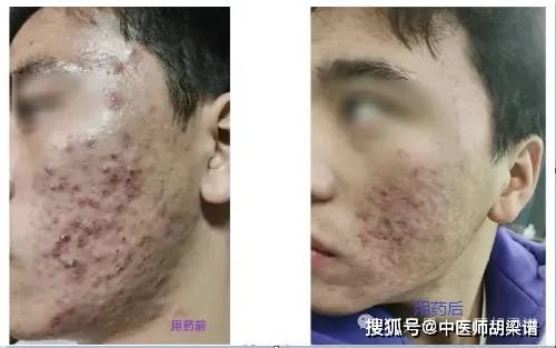 小伙轻松告别青春痘，颜值逆袭