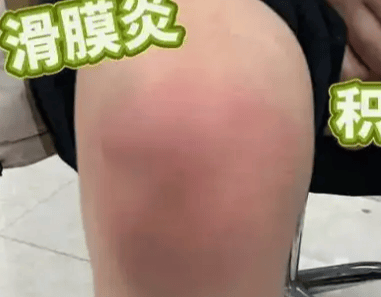 滑膜炎详细养护教程来了（本人已经好了，一年没复发）