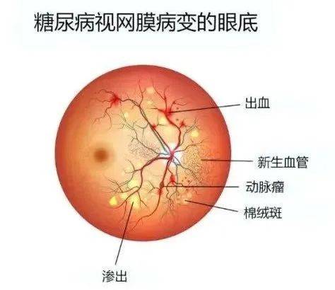 合肥普瑞眼科|如何早期发现“无声无息”的糖尿病视网膜病变？