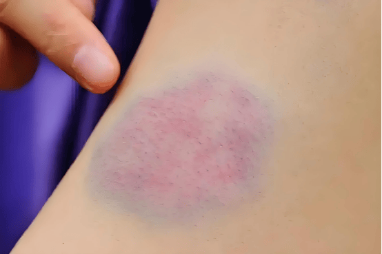 杨淑莲医生：血小板减少3周升板，中医五法稳血象