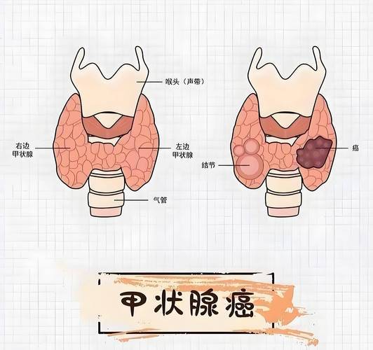 这4种癌症生存期很长，有“不死癌症” 之称！